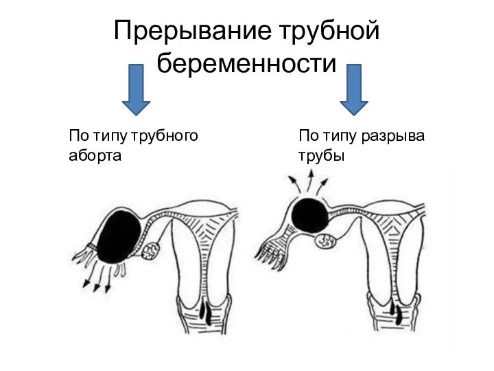 Прерывание трубной беременности По типу трубного аборта По типу разрыва трубы