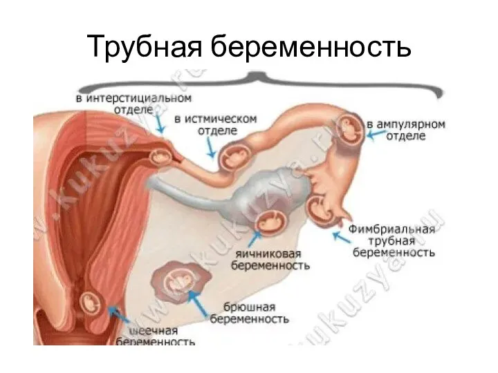 Трубная беременность