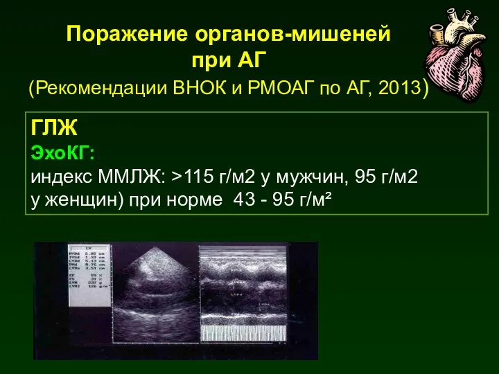 ГЛЖ ЭхоКГ: индекс ММЛЖ: >115 г/м2 у мужчин, 95 г/м2 у