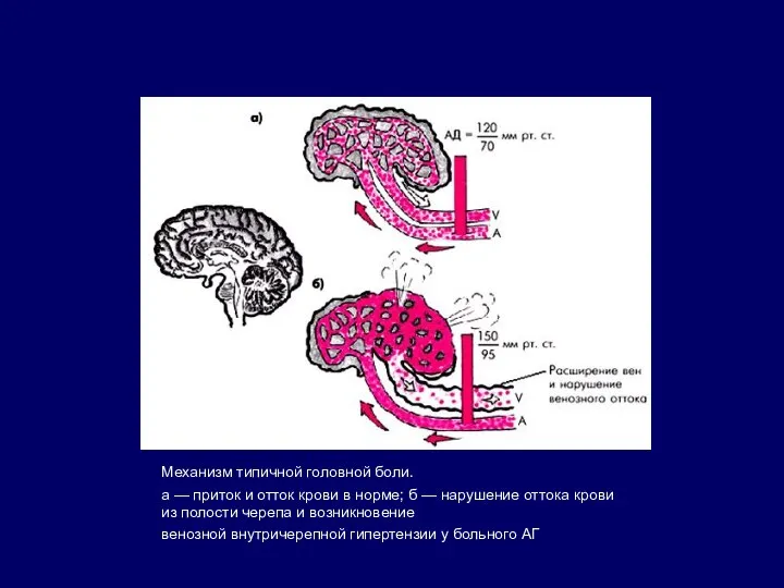 Механизм типичной головной боли. а — приток и отток крови в