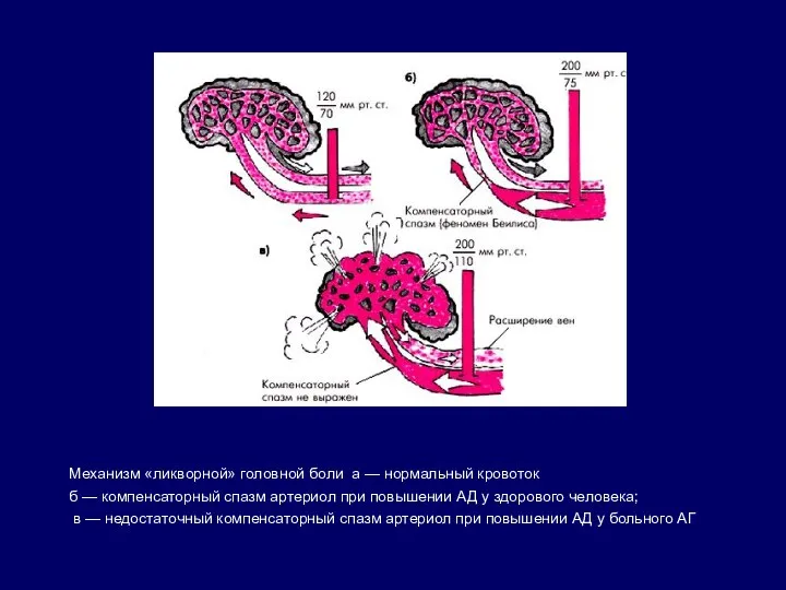 Механизм «ликворной» головной боли а — нормальный кровоток б — компенсаторный