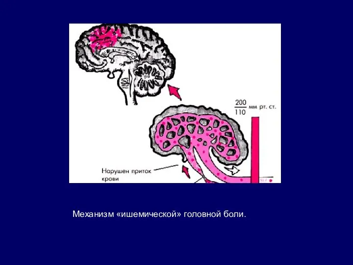 Механизм «ишемической» головной боли.