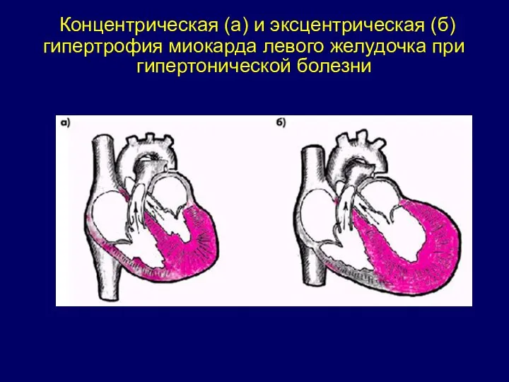 Концентрическая (а) и эксцентрическая (б) гипертрофия миокарда левого желудочка при гипертонической болезни