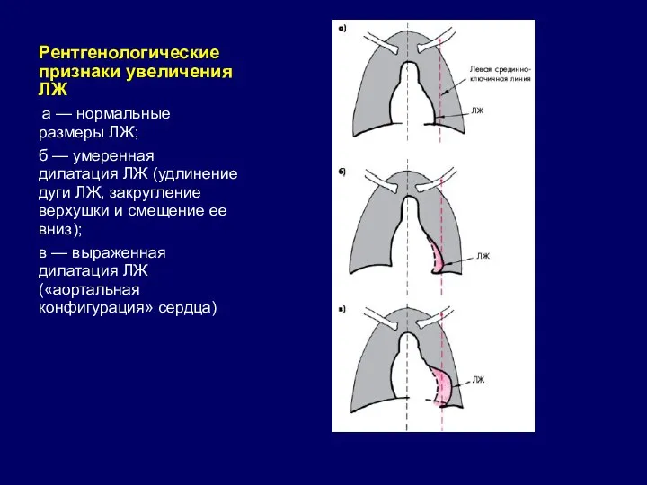 Рентгенологические признаки увеличения ЛЖ а — нормальные размеры ЛЖ; б —