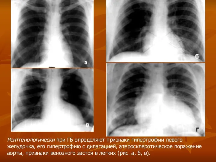 Рентгенологически при ГБ определяют признаки гипертрофии левого желудочка, его гипертрофию с