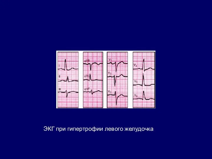 ЭКГ при гипертрофии левого желудочка