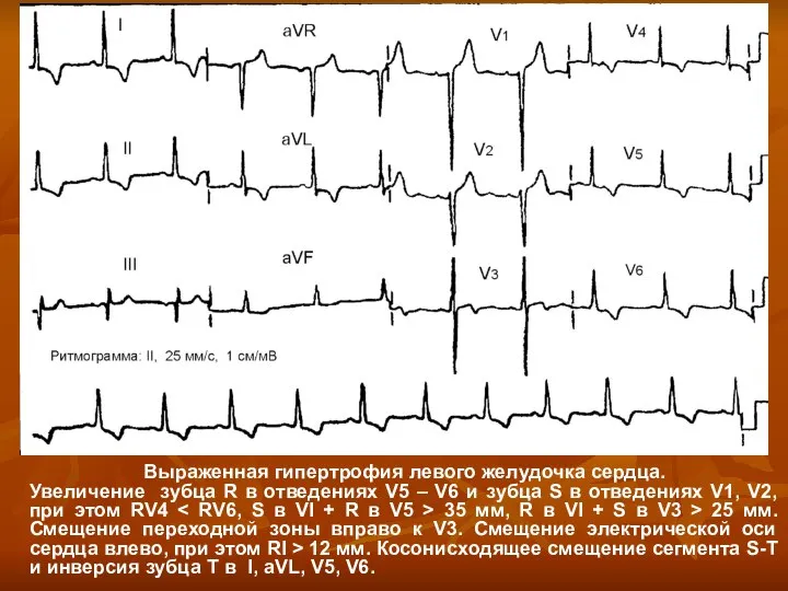 Выраженная гипертрофия левого желудочка сердца. Увеличение зубца R в отведениях V5