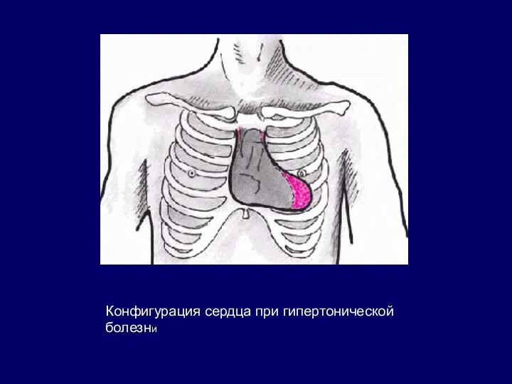 Конфигурация сердца при гипертонической болезни
