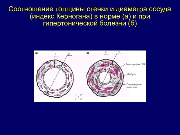 Соотношение толщины стенки и диаметра сосуда (индекс Керногана) в норме (а) и при гипертонической болезни (б)