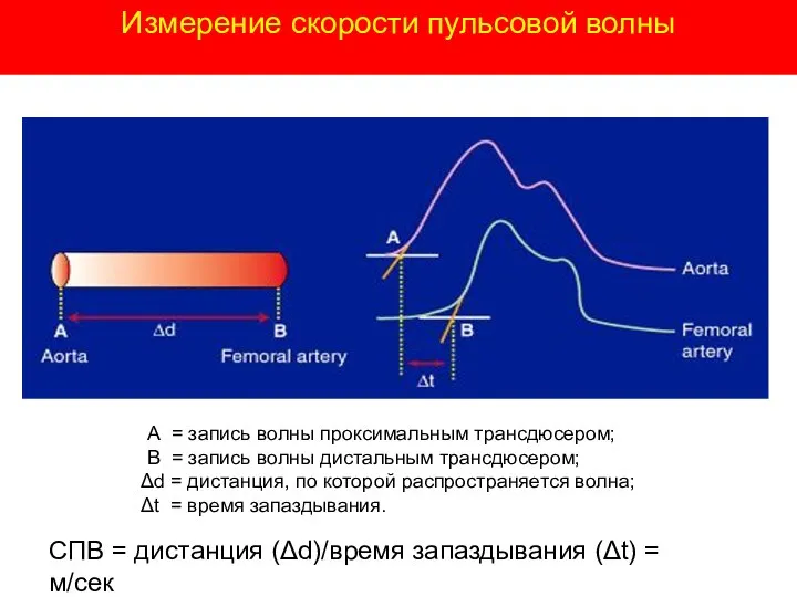 А = запись волны проксимальным трансдюсером; В = запись волны дистальным