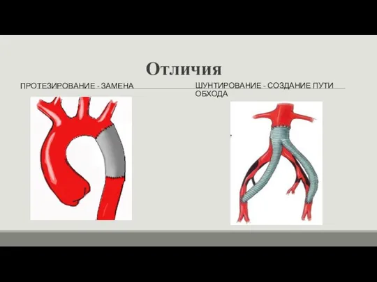 Отличия ШУНТИРОВАНИЕ - СОЗДАНИЕ ПУТИ ОБХОДА ПРОТЕЗИРОВАНИЕ - ЗАМЕНА