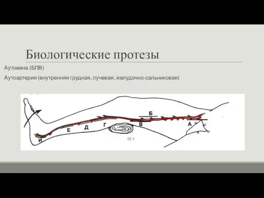 Биологические протезы Аутовена (БПВ) Аутоартерия (внутренняя грудная, лучевая, желудочно-сальниковая)