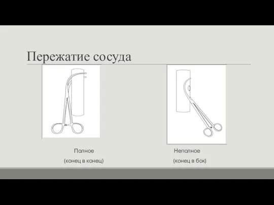 Пережатие сосуда Полное Неполное (конец в конец) (конец в бок)