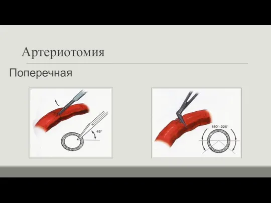 Артериотомия Поперечная