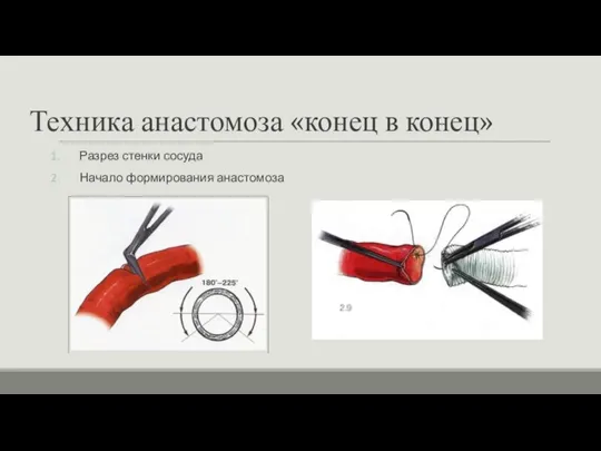 Техника анастомоза «конец в конец» Разрез стенки сосуда Начало формирования анастомоза