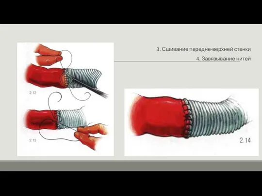 3. Сшивание передне-верхней стенки 4. Завязывание нитей