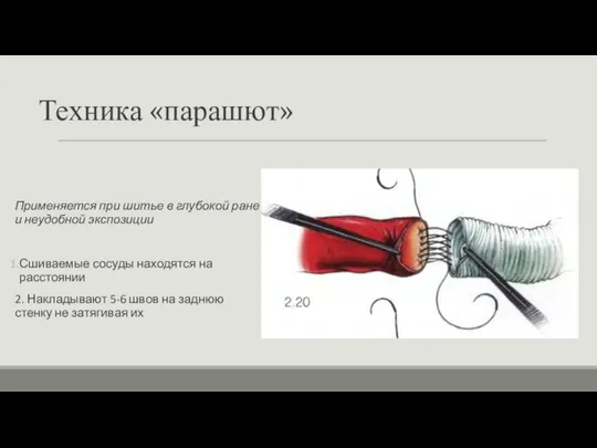 Техника «парашют» Применяется при шитье в глубокой ране и неудобной экспозиции