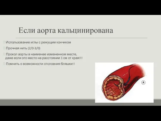 Если аорта кальцинирована Использование иглы с режущим кончиком Прочная нить (2/0-3/0)