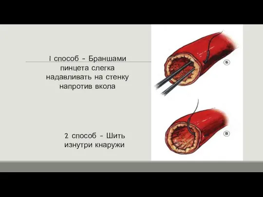 2 способ - Шить изнутри кнаружи 1 способ - Браншами пинцета