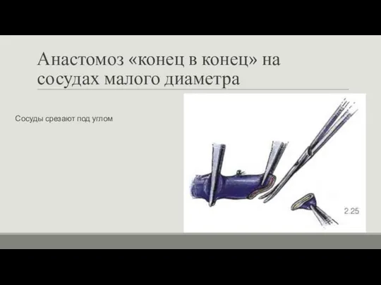 Анастомоз «конец в конец» на сосудах малого диаметра Сосуды срезают под углом