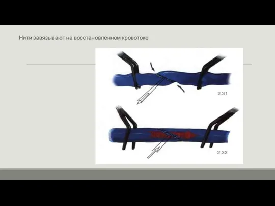 Нити завязывают на восстановленном кровотоке