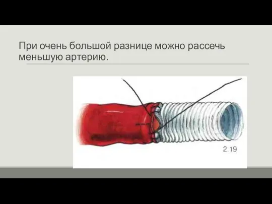 При очень большой разнице можно рассечь меньшую артерию.