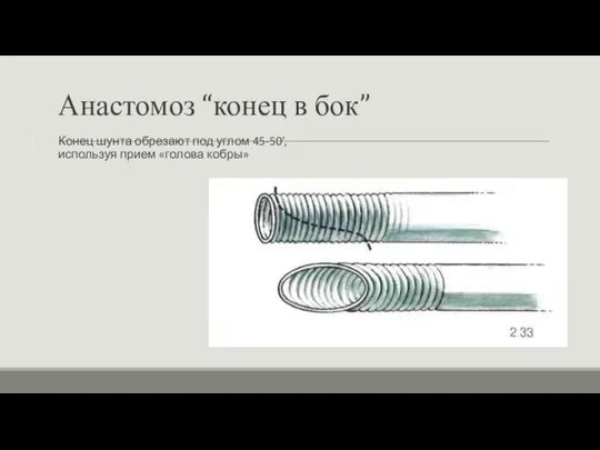 Анастомоз “конец в бок” Конец шунта обрезают под углом 45-50’, используя прием «голова кобры»