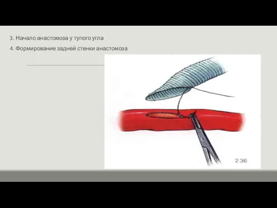 3. Начало анастомоза у тупого угла 4. Формирование задней стенки анастомоза