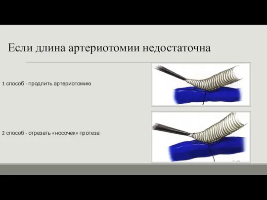 Если длина артериотомии недостаточна 1 способ - продлить артериотомию 2 способ - отрезать «носочек» протеза