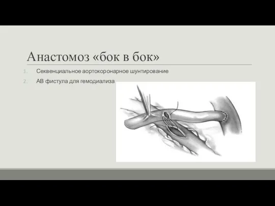 Анастомоз «бок в бок» Секвенциальное аортокоронарное шунтирование АВ фистула для гемодиализа