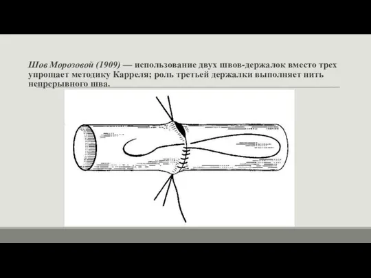 Шов Морозовой (1909) — использование двух швов-держалок вместо трех упрощает методику