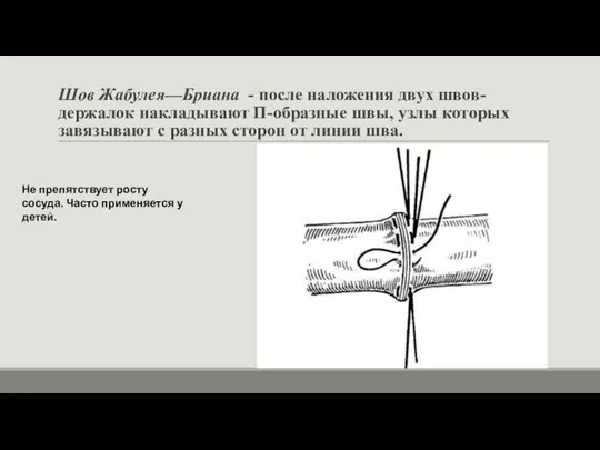 Шов Жабулея—Бриана - после наложения двух швов-держалок накладывают П-образные швы, узлы