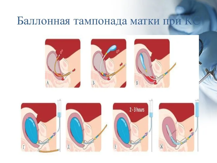 Баллонная тампонада матки при КС