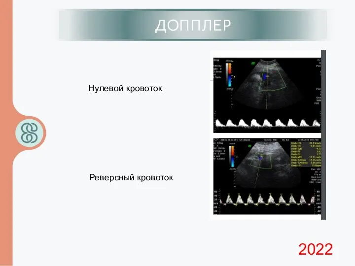 ИЦН ДОППЛЕР 2022 Нулевой кровоток Реверсный кровоток