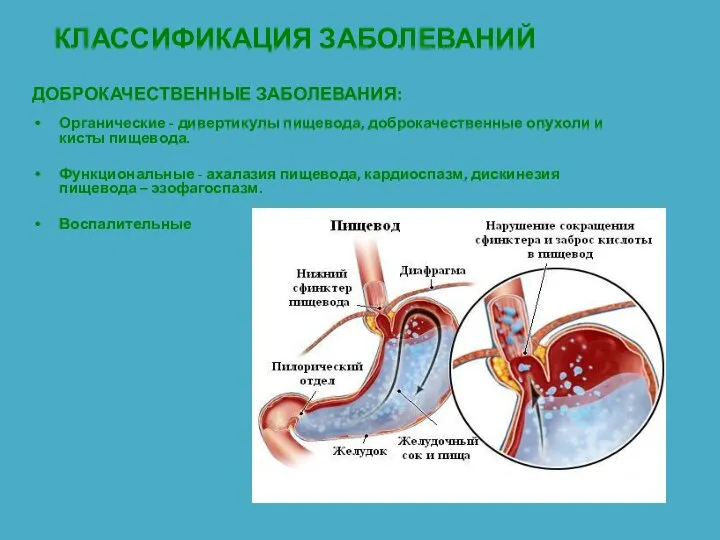 КЛАССИФИКАЦИЯ ЗАБОЛЕВАНИЙ ДОБРОКАЧЕСТВЕННЫЕ ЗАБОЛЕВАНИЯ: Органические - дивертикулы пищевода, доброкачественные опухоли и