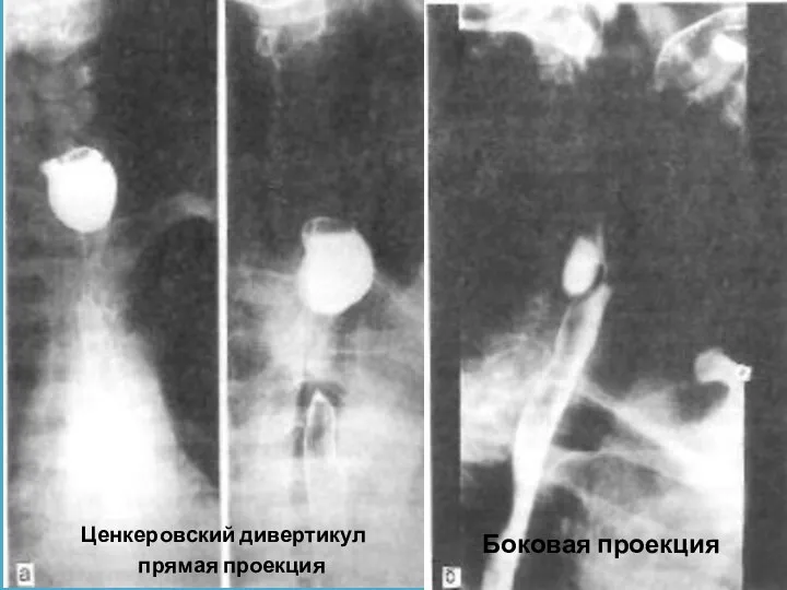 Ценкеровский дивертикул прямая проекция Боковая проекция