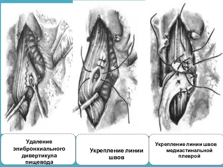 Удаление эпибронхиального дивертикула пищевода Укрепление линии швов Укрепление линии швов медиастинальной плеврой