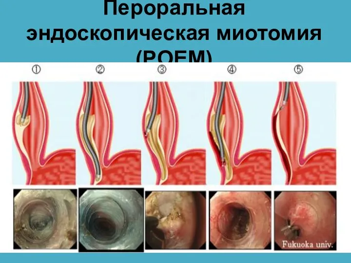 Пероральная эндоскопическая миотомия (POEM)