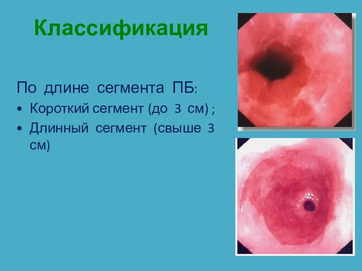 Классификация По длине сегмента ПБ: Короткий сегмент (до 3 см) ; Длинный сегмент (свыше 3 см)