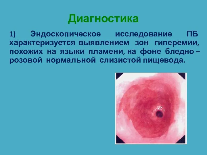 Диагностика 1) Эндоскопическое исследование ПБ характеризуется выявлением зон гиперемии, похожих на