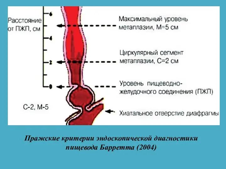 Пражские критерии эндоскопической диагностики пищевода Барретта (2004)