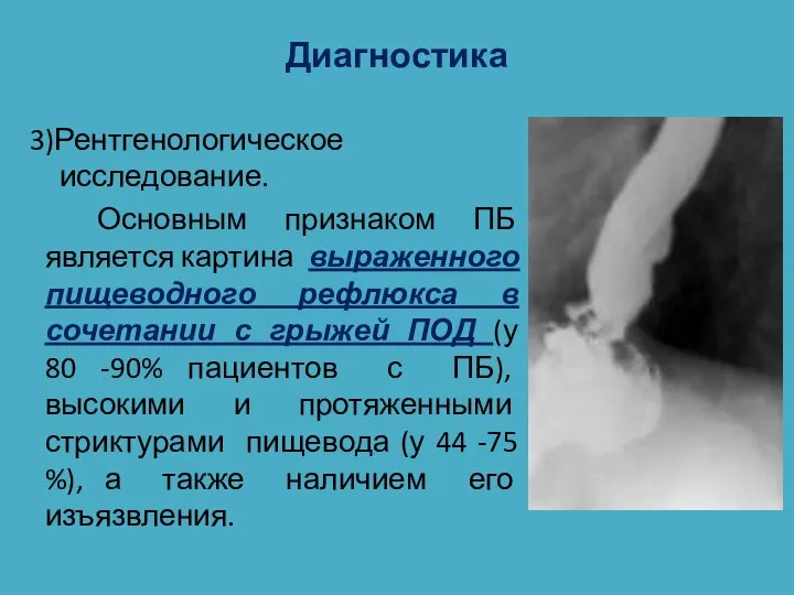 Диагностика 3)Рентгенологическое исследование. Основным признаком ПБ является картина выраженного пищеводного рефлюкса