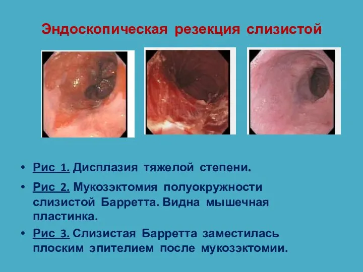 Эндоскопическая резекция слизистой Рис 1. Дисплазия тяжелой степени. Рис 2. Мукозэктомия