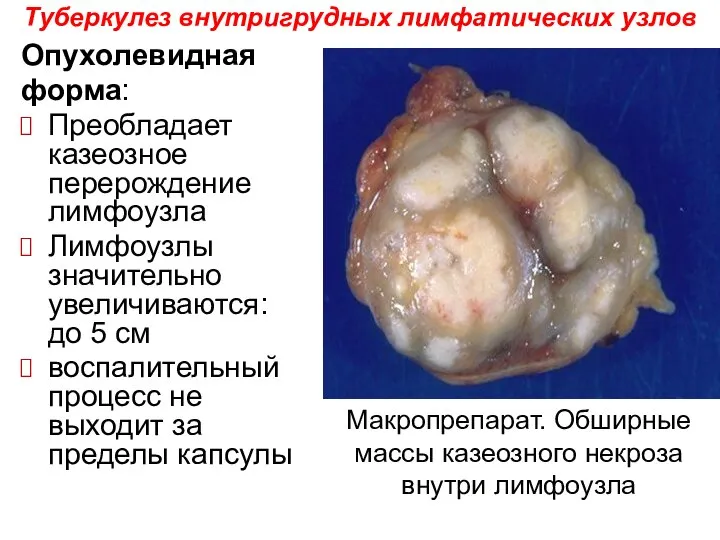 Опухолевидная форма: Преобладает казеозное перерождение лимфоузла Лимфоузлы значительно увеличиваются: до 5