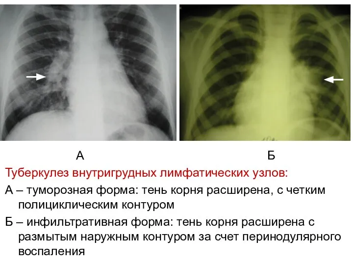 А Б Туберкулез внутригрудных лимфатических узлов: А – туморозная форма: тень