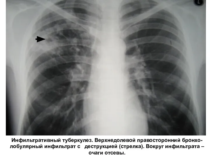 Инфильтративный туберкулез. Верхнедолевой правосторонний бронхо-лобулярный инфильтрат с деструкцией (стрелка). Вокруг инфильтрата – очаги отсевы.