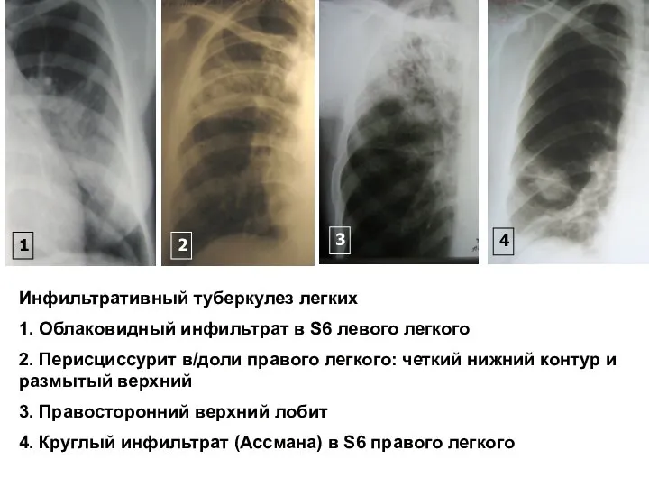 Инфильтративный туберкулез легких 1. Облаковидный инфильтрат в S6 левого легкого 2.