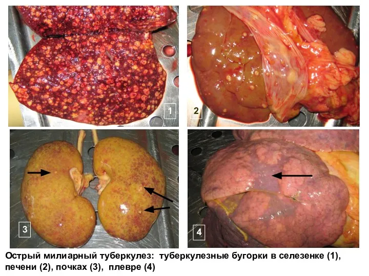 Острый милиарный туберкулез: туберкулезные бугорки в селезенке (1), печени (2), почках