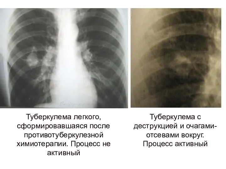 Туберкулема с деструкцией и очагами-отсевами вокруг. Процесс активный Туберкулема легкого, сформировавшаяся