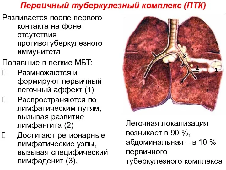 Первичный туберкулезный комплекс (ПТК) Развивается после первого контакта на фоне отсутствия